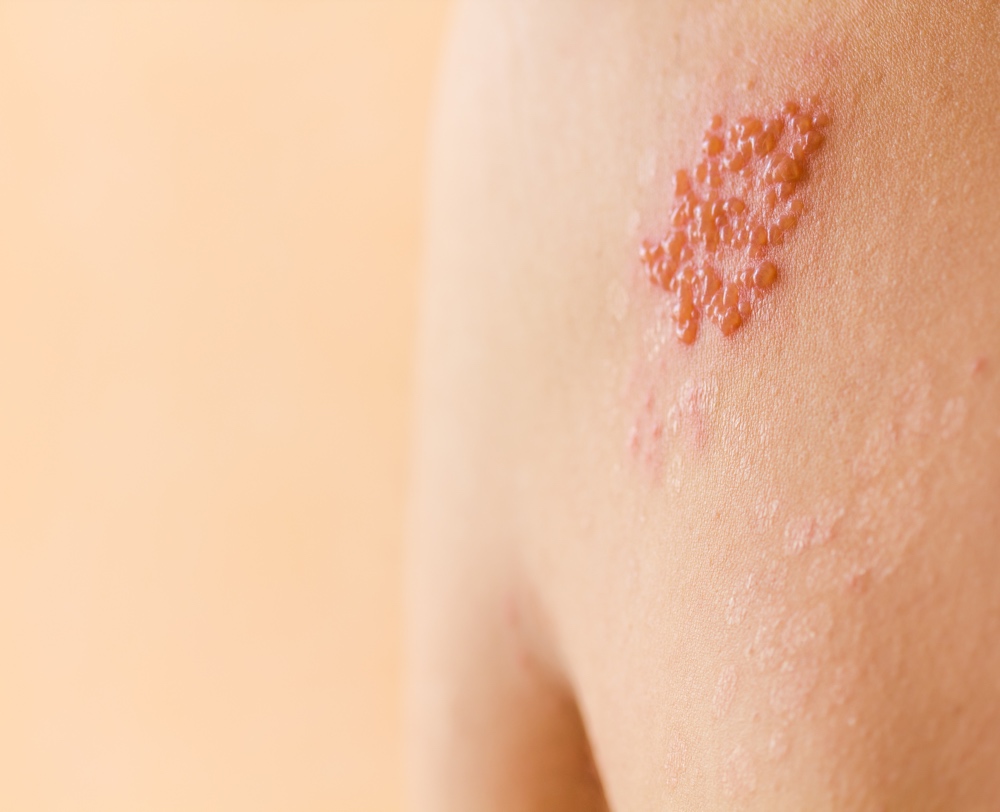 Shingles Vaccination Leeds, Bradford, Wakefield and surrounding areas
